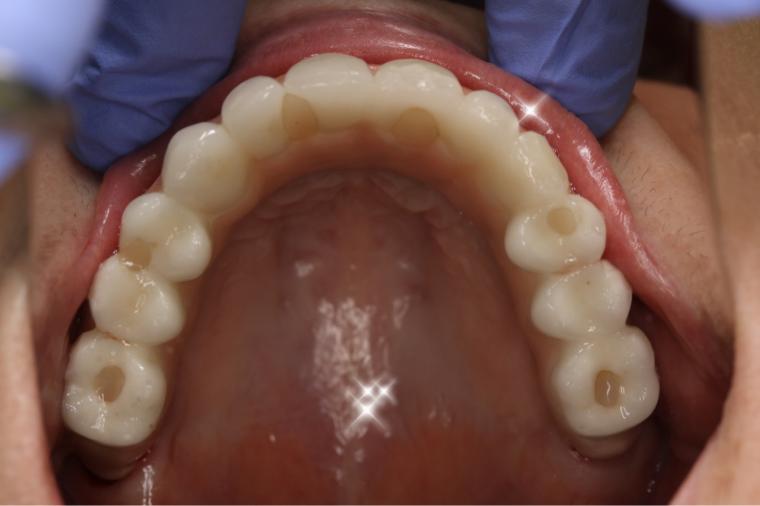インプラント治療(無歯顎)