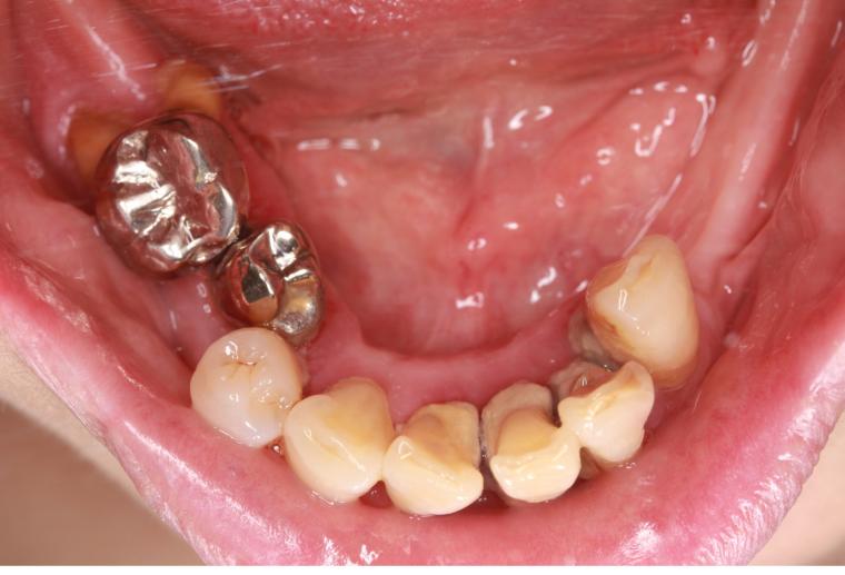 インプラント治療(無歯顎)